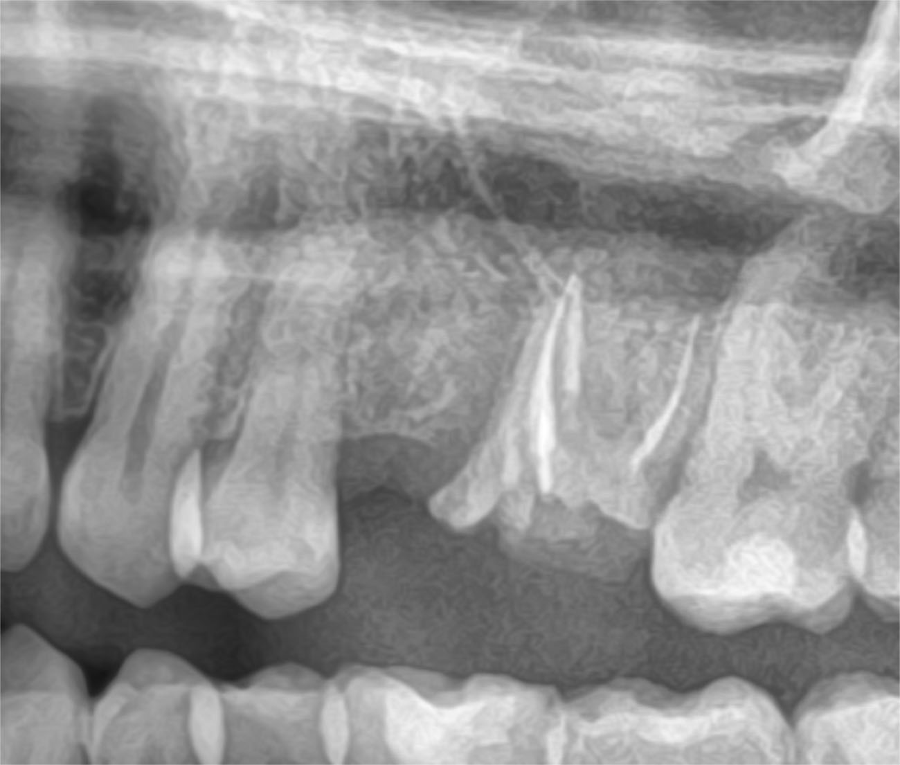 implant greffe osseuse CAS CLINIQUE dentiste lyon
