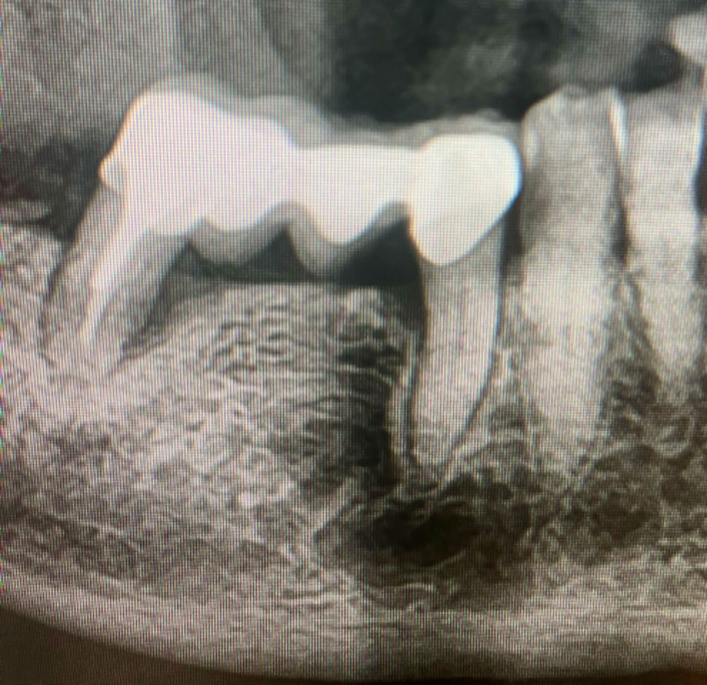 radiographie panoramique avant traitement