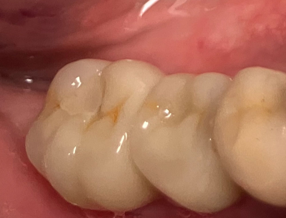 résultat final avec les dents en place