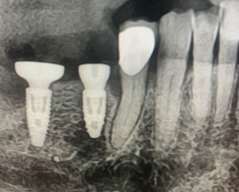 radiographie après pose des implants