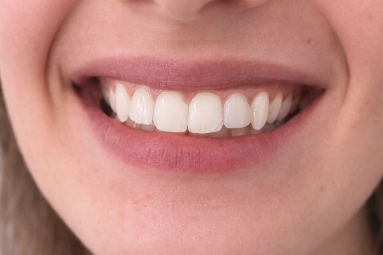 dent dévitalisée soins dentaire lyon