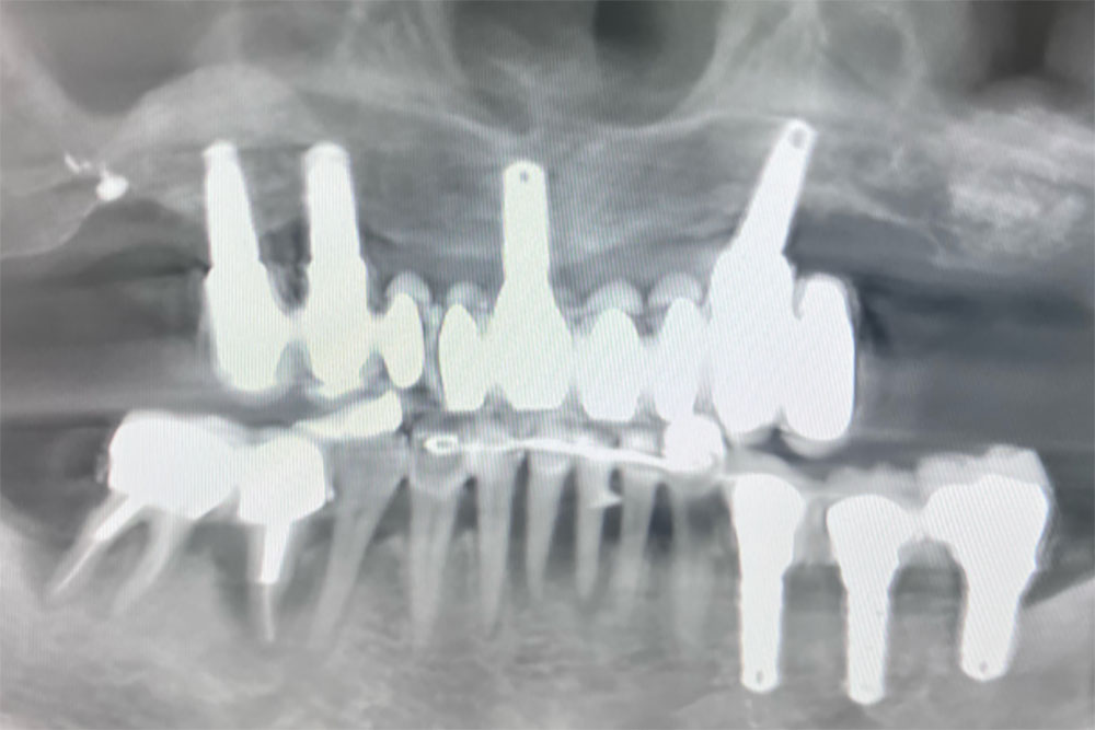 Chirurgie implantaire complexe lyon