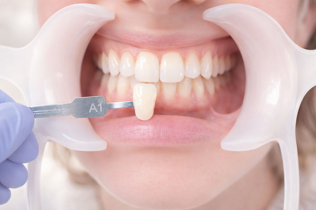 eclaircissement dentaire lyon labelia