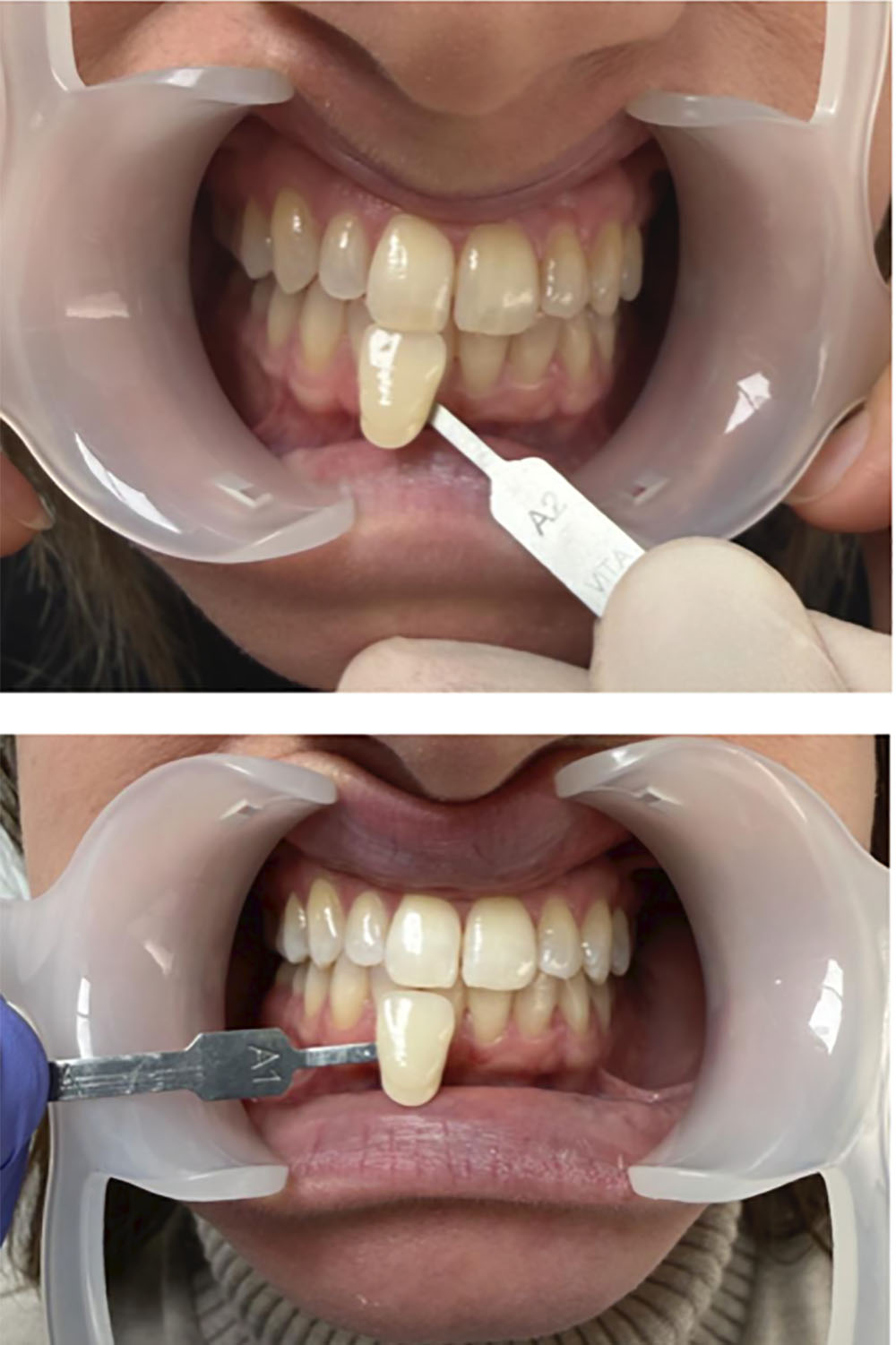 eclaircissement dentaire lyon