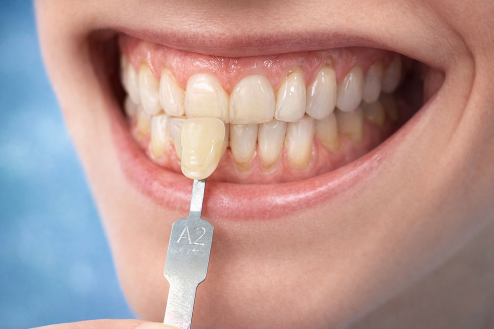 Comparaison de teintes dentaires A2 Lyon Labelia