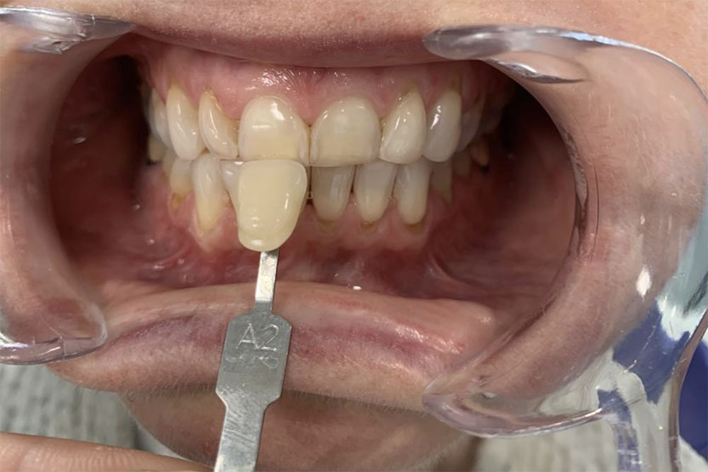 Éclaircissement dentaire externe avant lyon