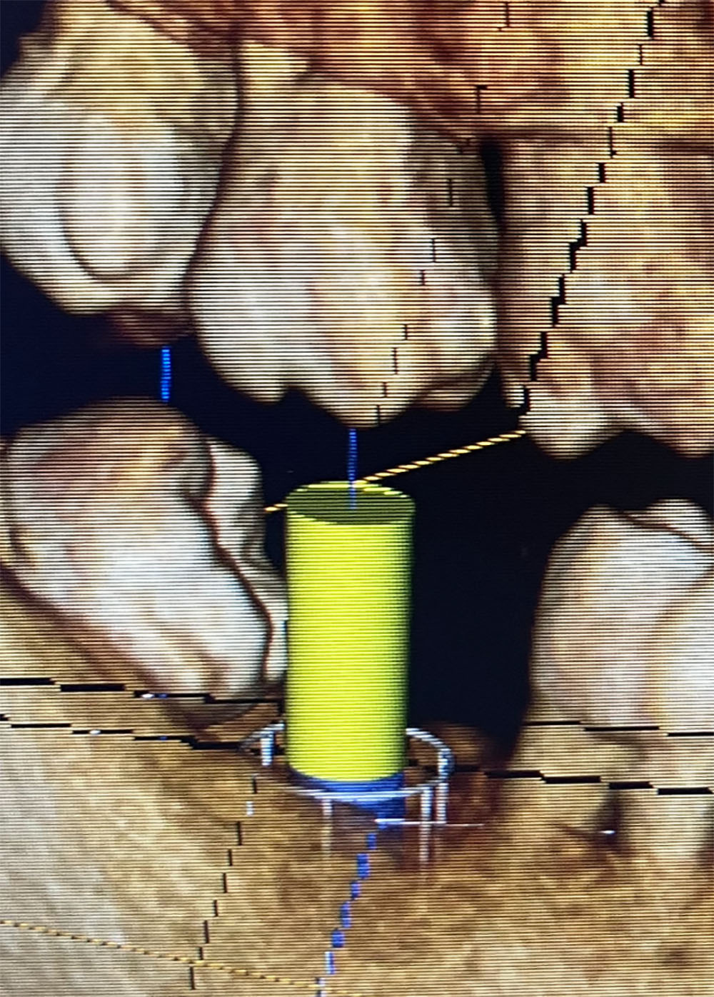 implant dent sagesse