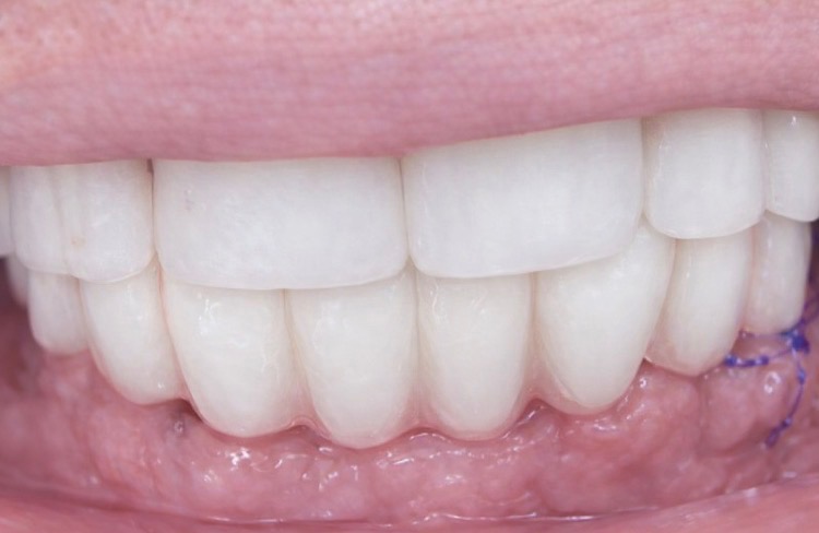 implant en une journee