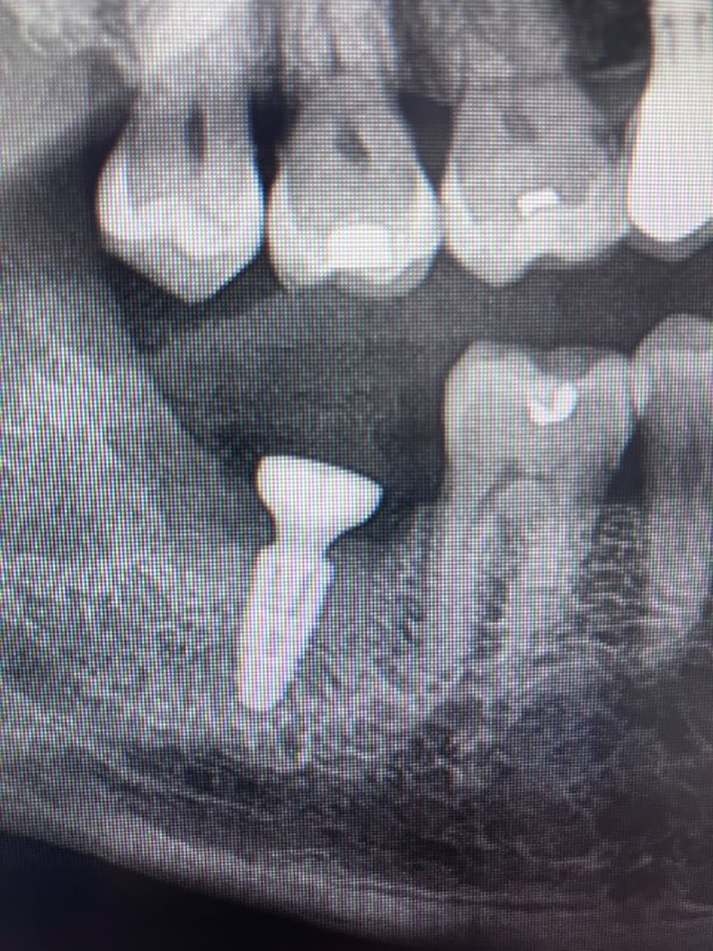 implant dent sagesse