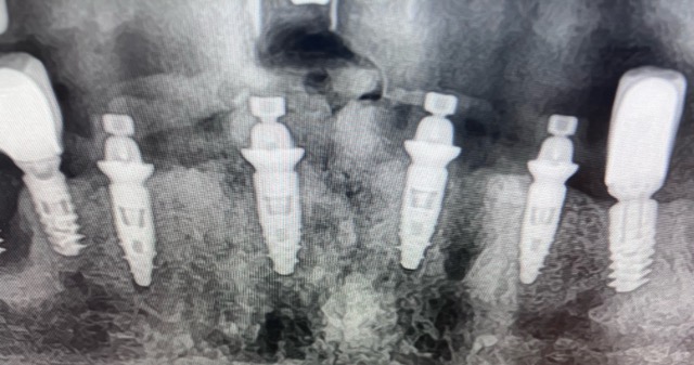 implant en une journee