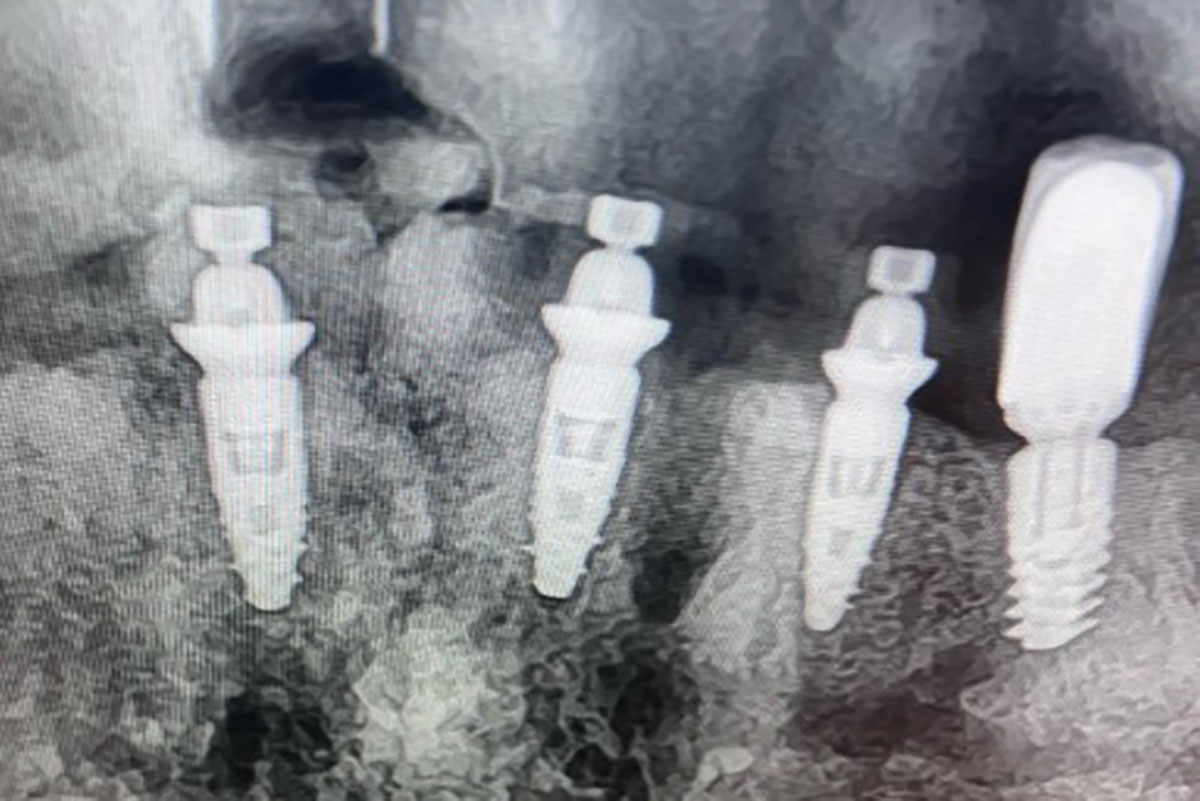 implant en une journee