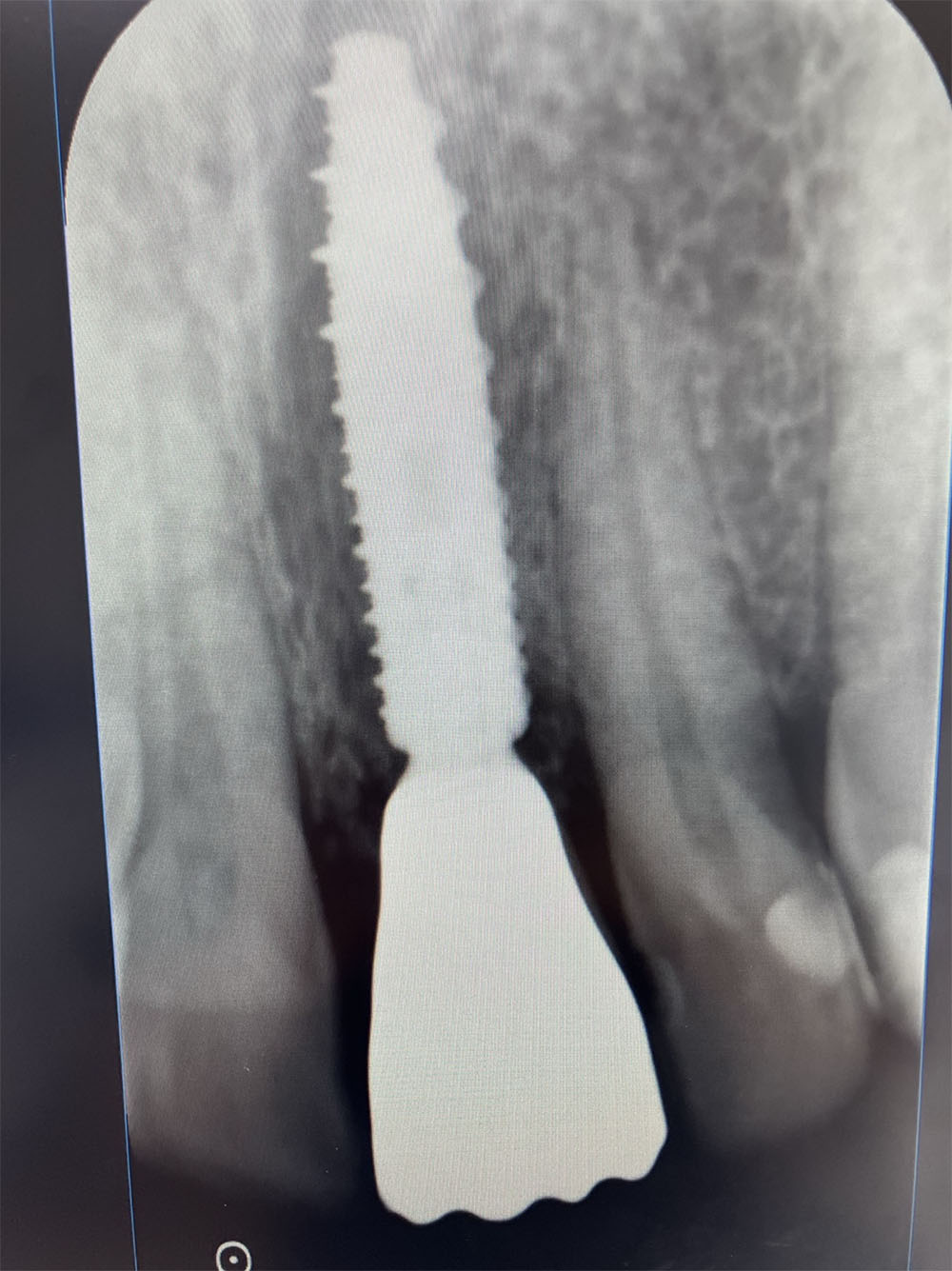 extraction – implantation immédiate