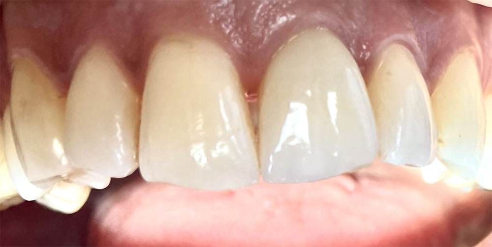 extraction – implantation immédiate