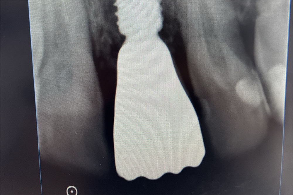 extraction – implantation immédiate
