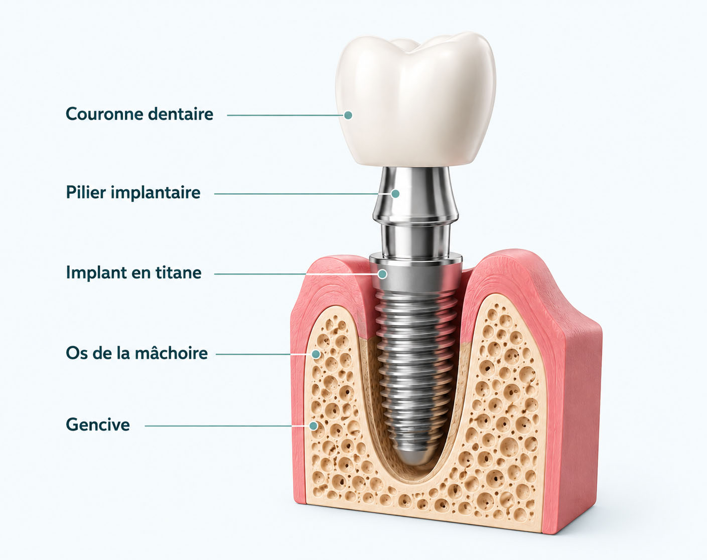 coupe implant 3D Lyon