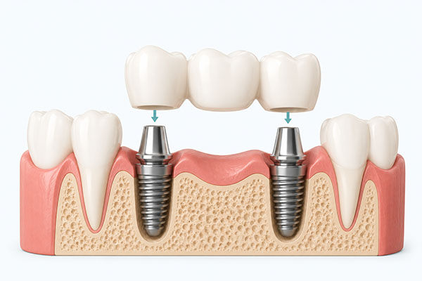 pont implant dentaire lyon