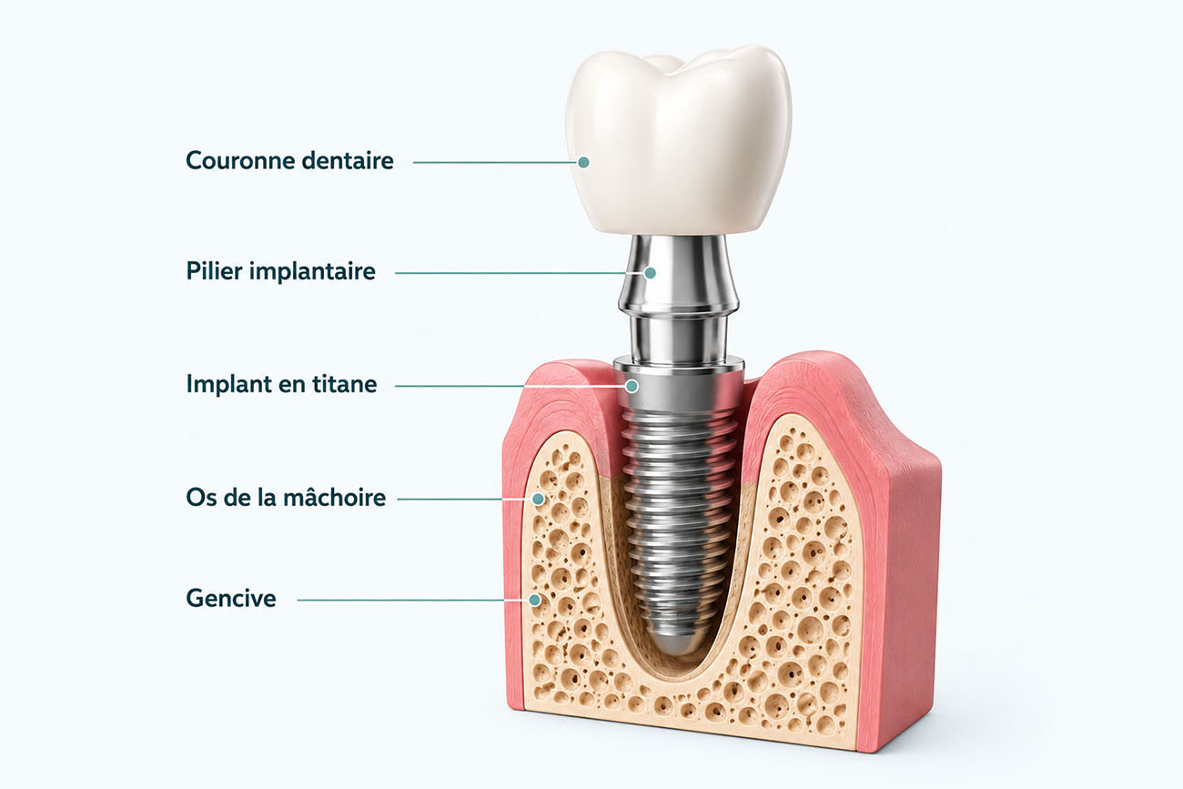 implant 3D Lyon labelia