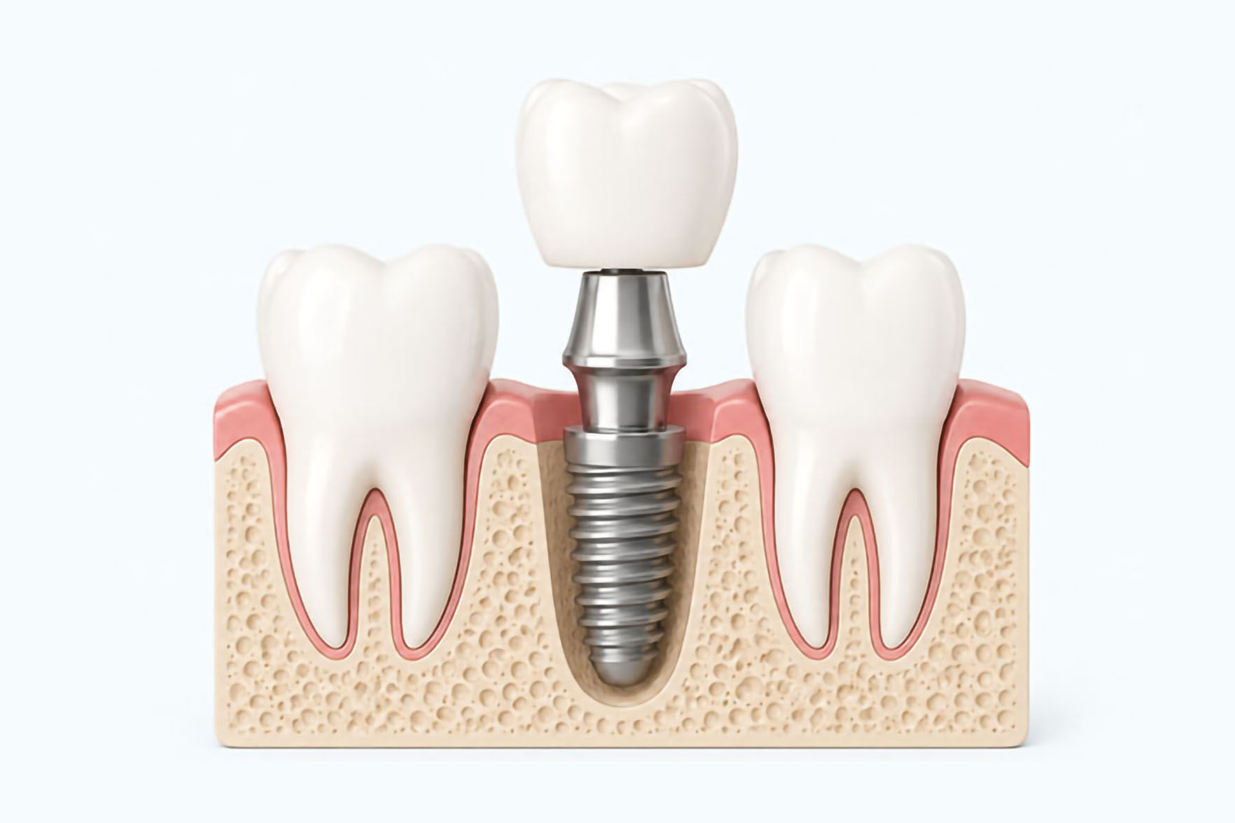 Dent manquante